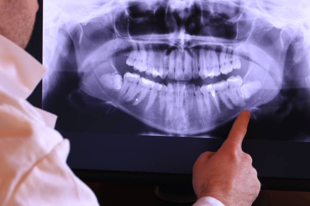 Best Emergency Wisdom Tooth Extraction in Downingtown, PA